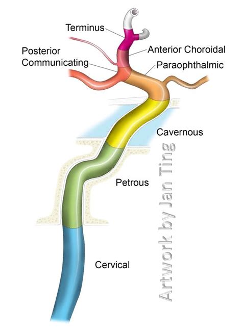 Internal Carotid Artery NYU Classification | Internal carotid artery ...