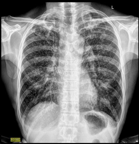 Tuberculosis Lung X Ray