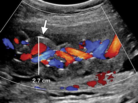 Comprehensive Imaging Review of Abnormalities of the Umbilical Cord | RadioGraphics