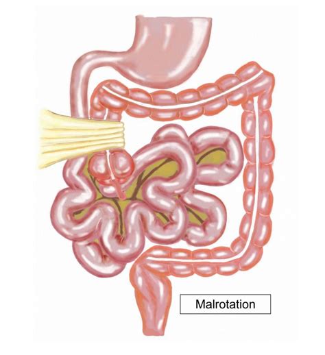 Intestinal malrotation - Royal Manchester Children's Hospital