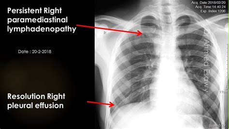 CASE 639 TB pleural effusion ,mediastinal lymphadenopathy - YouTube