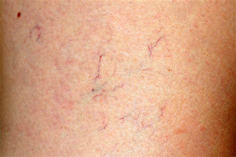 Spider veins: Causes, treatment, and prevention