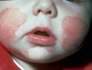 Contact dermatitis lips