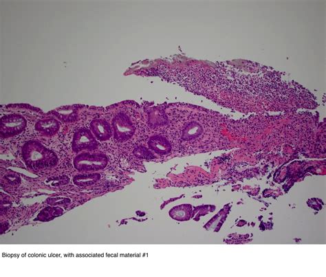 Pathology Outlines - Stercoral ulcer