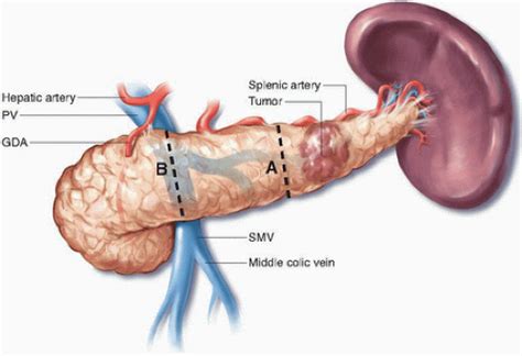 Distal Pancreatectomy | Oncohema Key