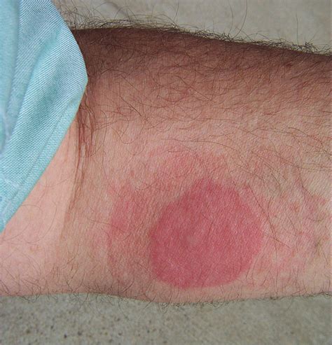 Identify Bed Bug Rash and How to Treat The Bites and Itch