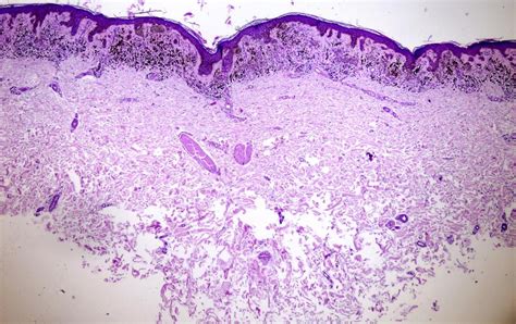 Pathology Outlines - Dysplastic nevus