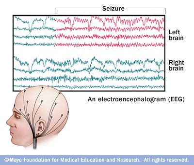 Brain Surgery For Epilepsy - Home