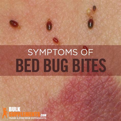 Bed Bug Vs Flea Bites