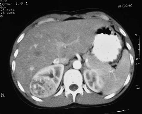 Ultrasound and CT imaging assessment of renal angiomyolipoma | BMJ Case ...