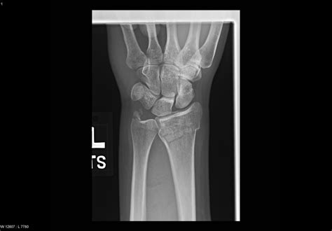 Fracture of distal ulna - Xray - radRounds Radiology Network