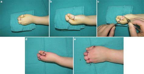 Amniotic Band Syndrome | Plastic Surgery Key