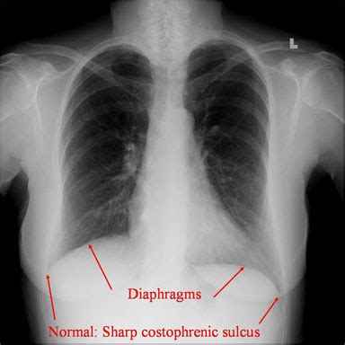 Pleura & Diaphragm – Toronto Notes