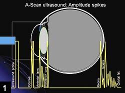 A-scan ultrasound amplitude spikes | Eye anatomy, Optometry, Eye cataract