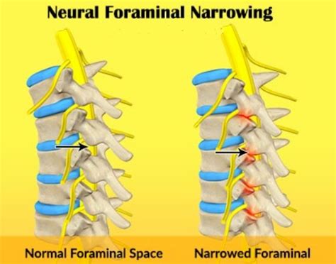 What is Neural Foraminal Stenosis (bilateral, mild, moderate, severe ...