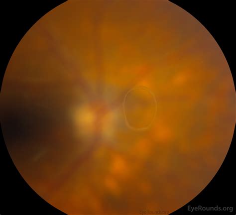 Retinal Hemorrhage Hypertension