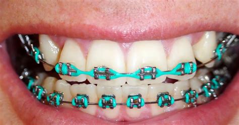 Braces Colors Green And Pink