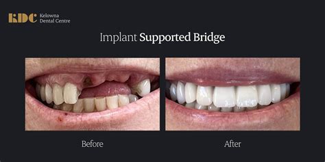 Implant-Supported Bridges | Dental Implants | Kelowna Dental Centre