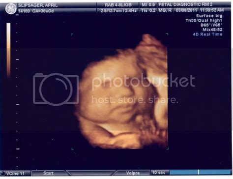 38 weeks 3 days Ultrasound Pics | BabyCenter