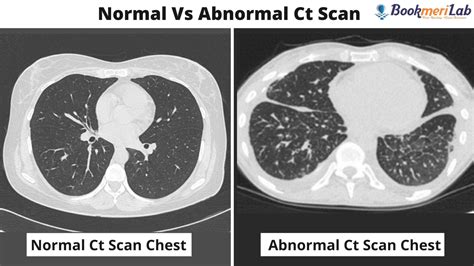 CT Scan Chest: Purpose, Results, COVID-19 & Cost [2022]