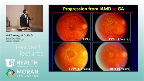 Geographic Atrophy in AMD: Clinical Features and Interventional Trials - YouTube