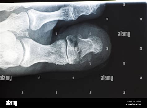 broken toe X Ray Stock Photo, Royalty Free Image: 33492638 - Alamy