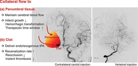 Collateral Circulation in Ischemic Stroke | Stroke