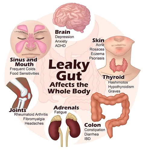 What Exactly Is Leaky Gut?? - Summit For Wellness