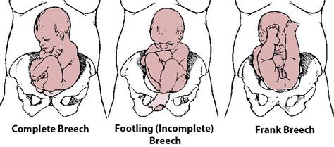 Breech baby causes, what does it mean and how to turn a breech baby