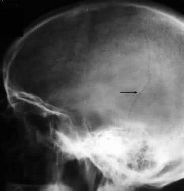 X Ray Of Skull Fracture Images