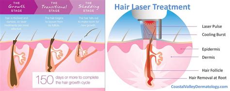 Laser Hair Removal | Coastal Valley Dermatology