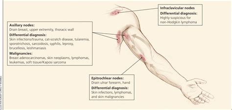 Unexplained Lymphadenopathy: Evaluation and Differential Diagnosis | AAFP