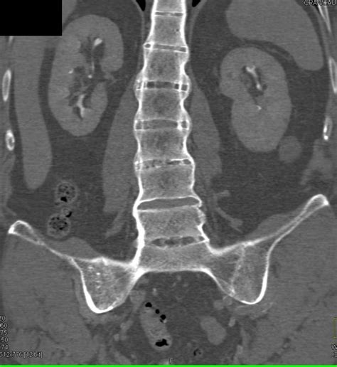 Ankylosing Spondylitis Mri Si Joint