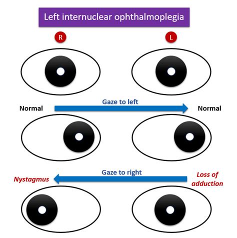 Site of lesion of internuclear ophthalmoplegia - Medicine MCQ « PG Blazer