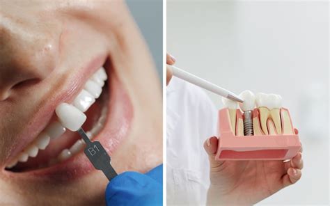 Veneers vs. Lumineers: What are the Differences? - Atrium Dental