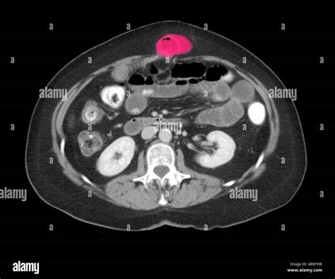 Ct Scan Sagittal View Showing An Abdominal Wall Hernia Stock Photo Alamy | My XXX Hot Girl