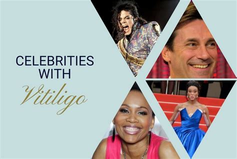 Famous Vitiligans – 57 Celebrities with Vitiligo – Unite For Vitiligo