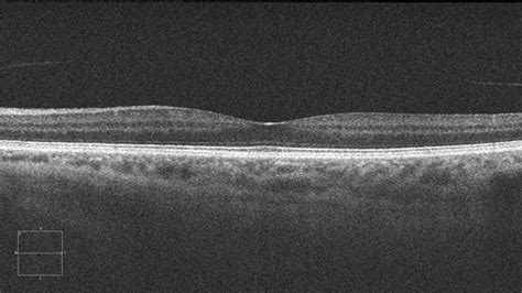 Optical Coherence Tomography (OCT) - Applecross Eye Clinic