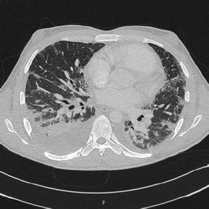 Initial CT scan of the lung of the patient showing the infiltrates on... | Download Scientific ...