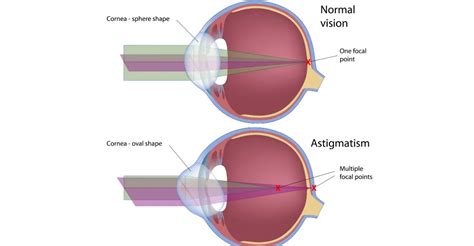 What Is Astigmatism and How Can It Be Corrected? - DMEI | Dean McGee Eye Institute