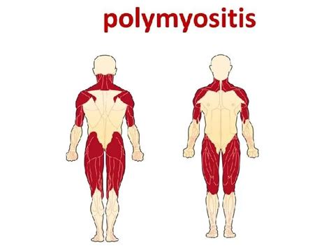 Polymyositis - Cause, Symptoms, Diagnosis, Treatment