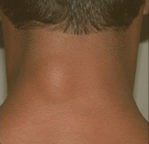 Lump on Back of Neck, Hairline, under Skin, Right Side, Left, Near ...