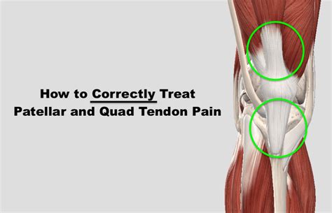 Fixing Patellar & Quad Tendon Pain (2022)