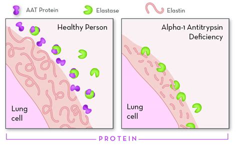 Alpha-1 Antitrypsin Deficiency