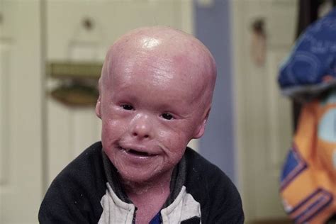 Five-Year-Old's Skin Grows At 10 Times The Normal Rate | Boys who, Ichthyosis, Skin