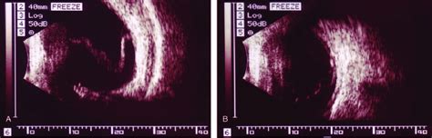 Ultrasound B-mode echography photograph of the patient's right eye (A)... | Download Scientific ...