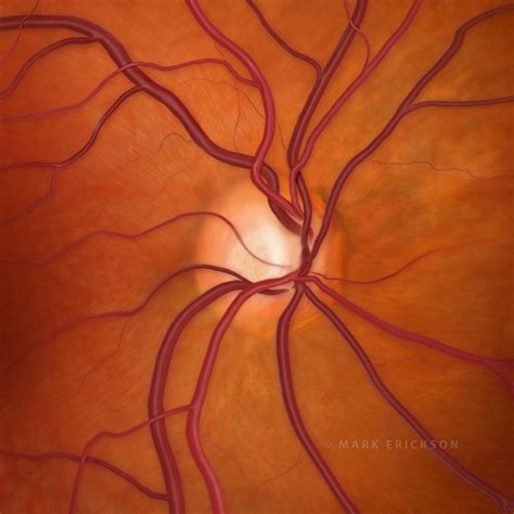 Optic nerve cupping in glaucoma, 0.6 c/d ratio, glaucoma illustration