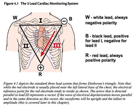 Einthoven's Triangle correlates to 3-lead cardiac monitoring leads ...