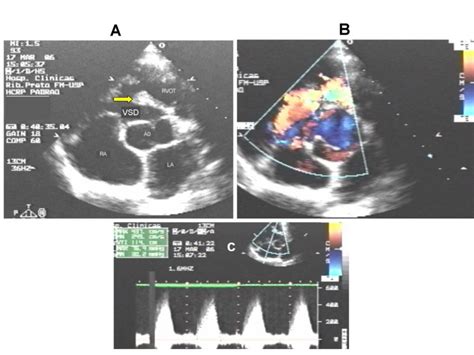 Double-chambered right ventricle in an adult patient diagnosed by ...