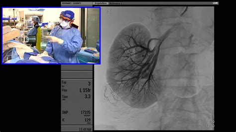 Transradial Balloon-Assisted Onyx Embolization of Renal Angiomyolipoma - YouTube